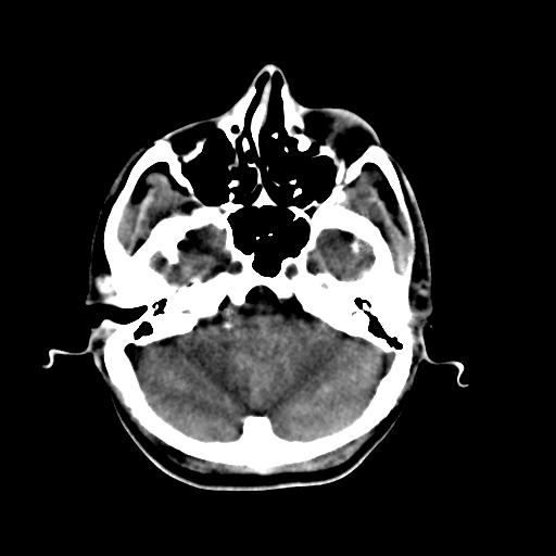 Cerebral arteriovenous malformation (Radiopaedia 28518-28759 Axial non-contrast 15).jpg