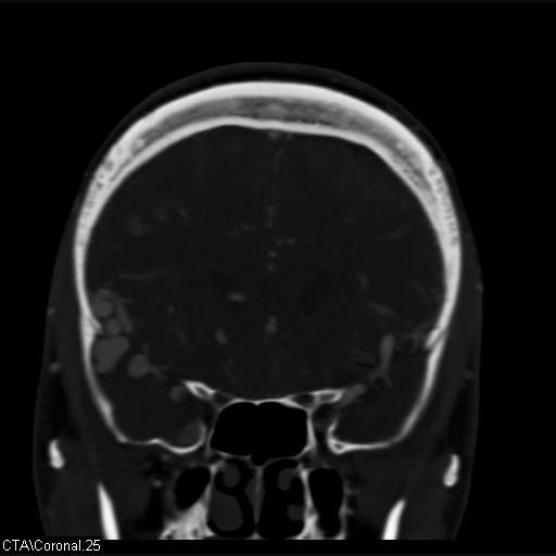 Cerebral arteriovenous malformation (Radiopaedia 28518-28759 C 25).jpg