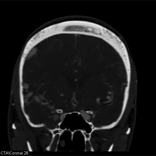 Cerebral arteriovenous malformation (Radiopaedia 28518-28759 C 28).jpg