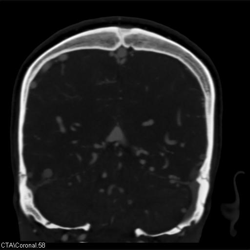 Cerebral arteriovenous malformation (Radiopaedia 28518-28759 C 58).jpg