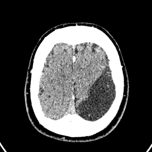 Cerebral arteriovenous malformation (Radiopaedia 37182-39012 Axial non-contrast 41).jpg