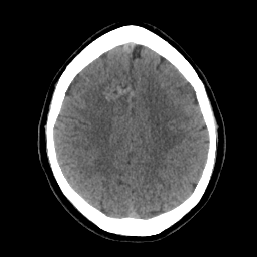 File:Cerebral arteriovenous malformation (Radiopaedia 39259-41505 Brain Ax 5mm 20).png