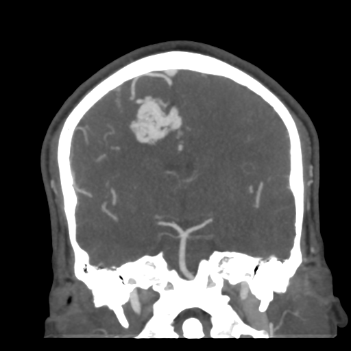Cerebral arteriovenous malformation (Radiopaedia 39259-41505 E 34).png