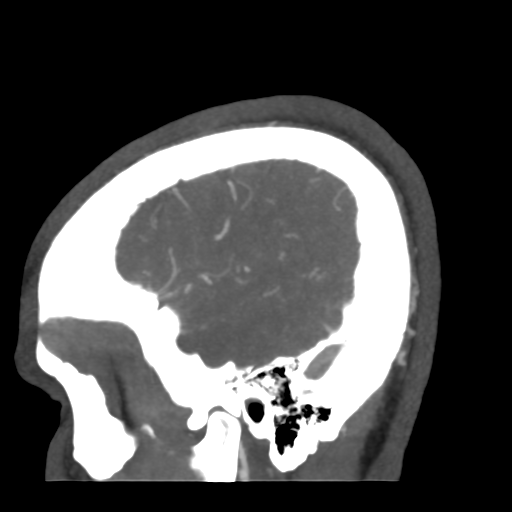 Cerebral arteriovenous malformation (Radiopaedia 39259-41505 Sagittal 10).png
