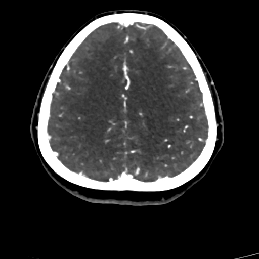 Cerebral arteriovenous malformation (Radiopaedia 73830-84645 Axial C+ delayed 23).jpg