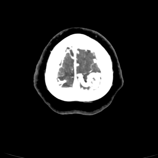 Cerebral arteriovenous malformation (Radiopaedia 73830-84645 Axial C+ delayed 4).jpg