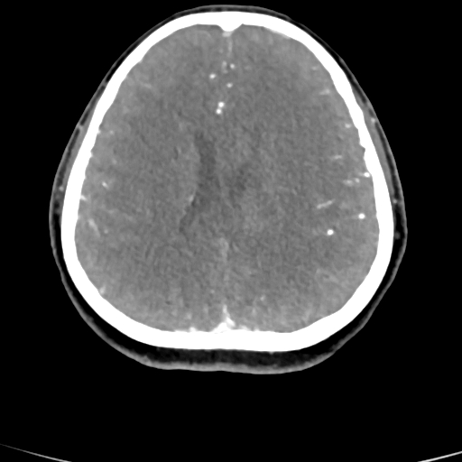 Cerebral arteriovenous malformation (Radiopaedia 73830-84645 B 38).jpg