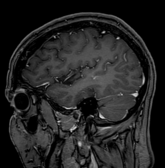 Cerebral arteriovenous malformation (Radiopaedia 74411-85746 Sagittal T1 C+ 25).jpg