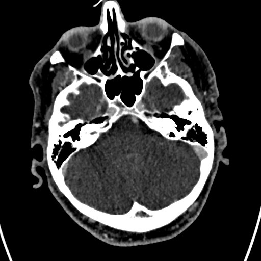 Cerebral arteriovenous malformation (Radiopaedia 78188-90746 Axial C+ delayed 41).jpg