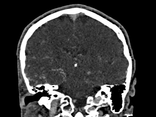 Cerebral arteriovenous malformation (Radiopaedia 78188-90746 Coronal C+ delayed 71).jpg