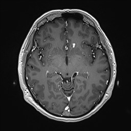 Cerebral arteriovenous malformation (Radiopaedia 84015-99245 Axial T1 C+ 73).jpg