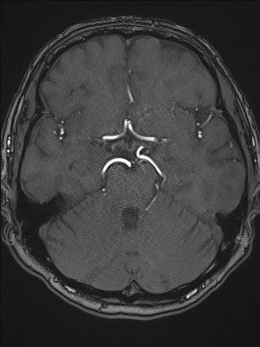 Cerebral arteriovenous malformation (Radiopaedia 84015-99245 Axial TOF 100).jpg