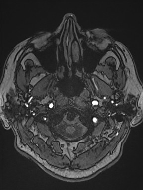 Cerebral arteriovenous malformation (Radiopaedia 84015-99245 Axial TOF 34).jpg