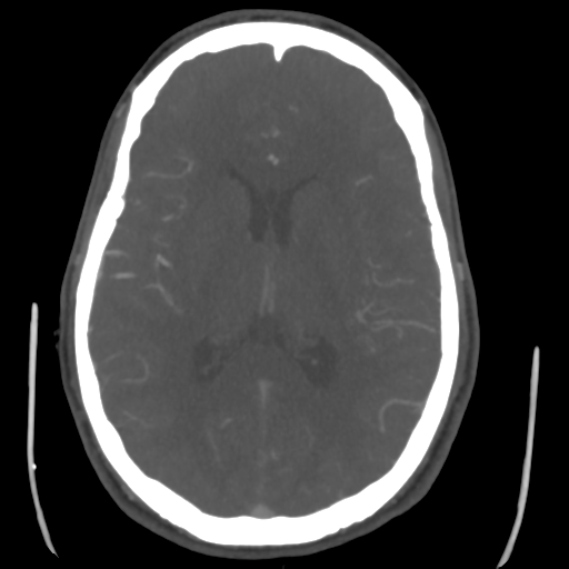 Cerebral arteriovenous malformation (Spetzler-Martin grade 2) (Radiopaedia 41262-44076 E 30).png