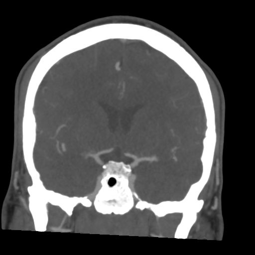 File:Cerebral arteriovenous malformation (Spetzler-Martin grade 2) (Radiopaedia 41262-44076 F 28).png