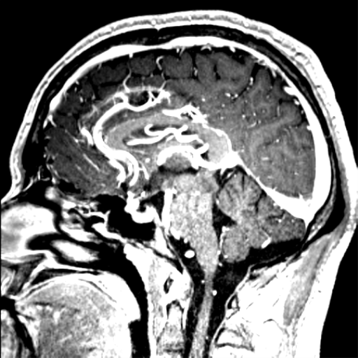 Cerebral arteriovenous malformation - huge (Radiopaedia 35734-37272 Axial T1 C+ 79).png