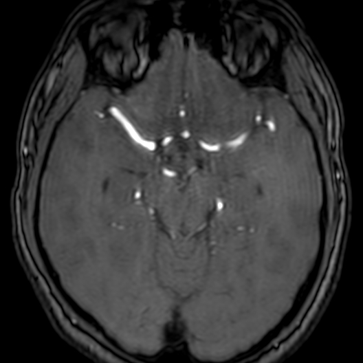 Cerebral arteriovenous malformation at posterior body of corpus callosum (Radiopaedia 74111-84925 Axial MRA 82).jpg