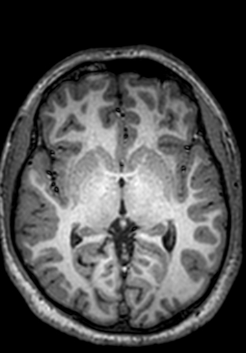 Cerebral arteriovenous malformation at posterior body of corpus callosum (Radiopaedia 74111-84925 Axial T1 157).jpg