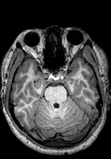 Cerebral arteriovenous malformation at posterior body of corpus callosum (Radiopaedia 74111-84925 Axial T1 212).jpg
