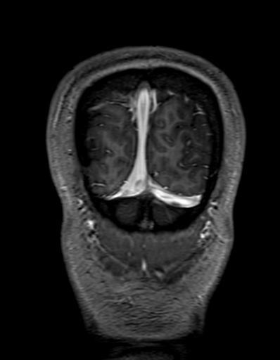 Cerebral arteriovenous malformation at posterior body of corpus callosum (Radiopaedia 74111-84925 K 348).jpg