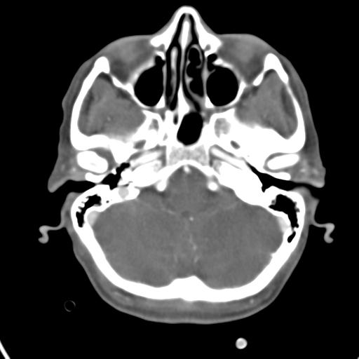 Cerebral arteriovenous malformation with hemorrhage (Radiopaedia 28773-29073 A 43).jpg