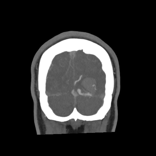 Cerebral arteriovenous malformation with lobar hemorrhage (Radiopaedia 35598-57216 C 83).jpg