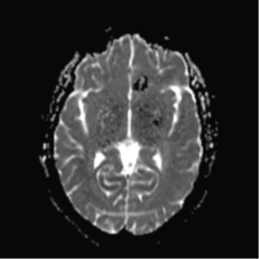 File:Cerebral cavernoma and development venous anomaly (Radiopaedia 37603-39482 Axial ADC 11).png
