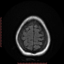File:Cerebral cavernous malformation (Radiopaedia 26177-26306 FLAIR 19).jpg