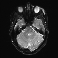 Cerebral cavernous venous malformation (Radiopaedia 70008-80021 Axial DWI 9).jpg