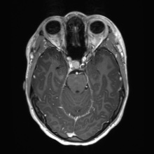 Cerebral cavernous venous malformation (Radiopaedia 70008-80021 Axial T1 C+ 24).jpg