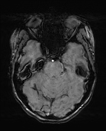 Cerebral cavernous venous malformation (Radiopaedia 70008-80021 I 23).jpg
