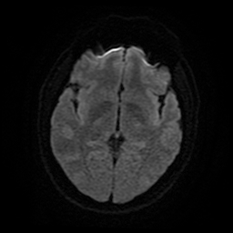 File:Cerebral cavernous venous malformation (Zabramski type II) (Radiopaedia 85511-101198 Axial DWI 16).jpg