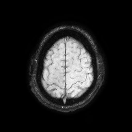 Cerebral cavernous venous malformation (Zabramski type II) (Radiopaedia 85511-101198 Axial SWI 101).jpg
