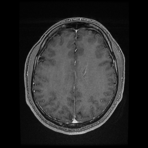 Cerebral cavernous venous malformation (Zabramski type II) (Radiopaedia 85511-101198 Axial T1 C+ fat sat 33).jpg