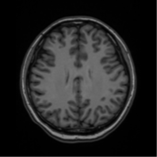 File:Cerebral cavernous venous malformations (Radiopaedia 48117-52946 Axial T1 31).png