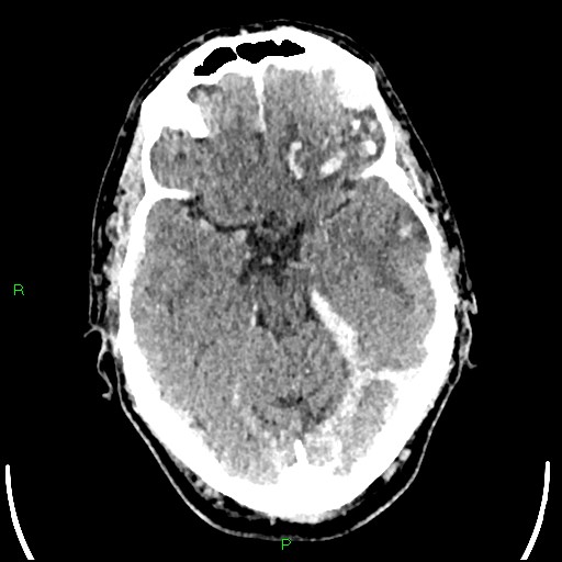 File:Cerebral contusions (Radiopaedia 33868-35039 Axial non-contrast 75).jpg