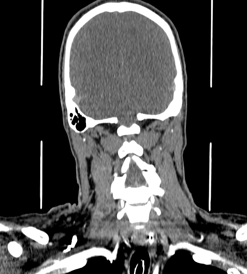 Cerebral edema in an overdose patient (Radiopaedia 72005-82539 B 129).jpg