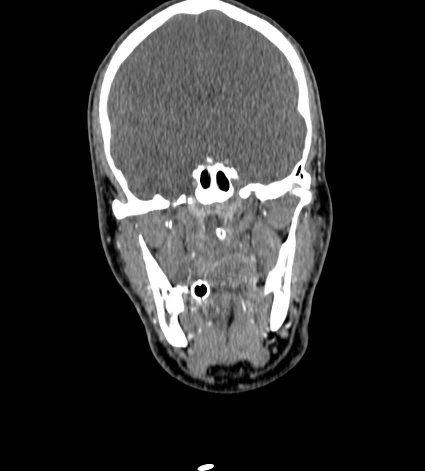 Cerebral edema in an overdose patient (Radiopaedia 72005-82539 B 26).jpg