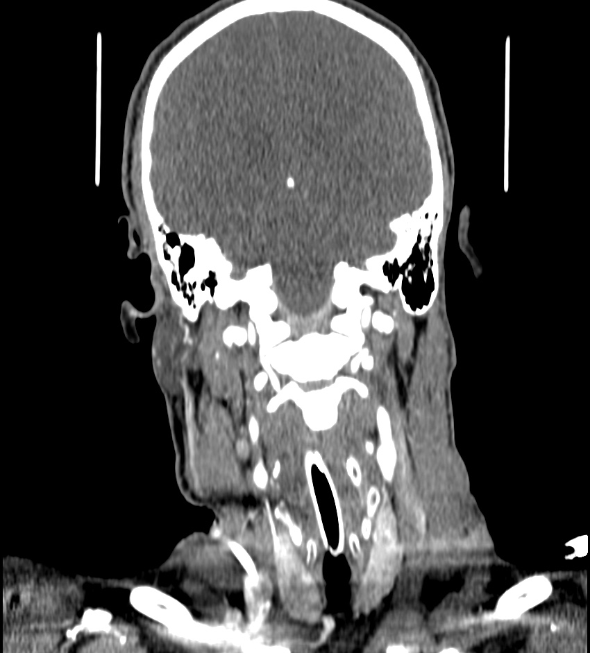 Cerebral edema in an overdose patient (Radiopaedia 72005-82539 B 88).jpg