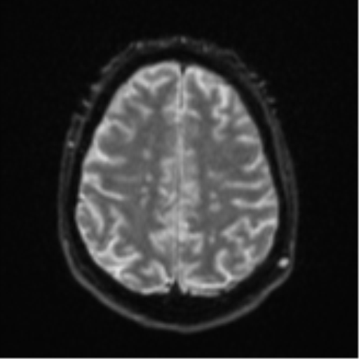 File:Cerebral embolic infarcts (embolic shower) (Radiopaedia 57395-64342 Axial DWI 27).png