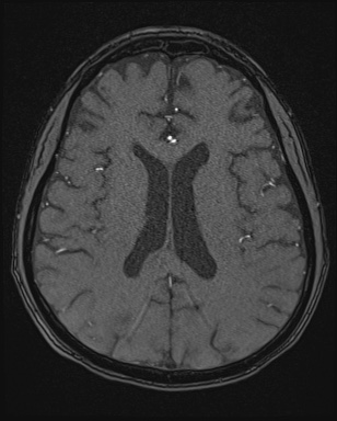 Cerebral embolic infarcts (embolic shower) (Radiopaedia 72391-82921 Axial MRA 118).jpg