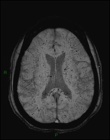 Cerebral fat embolism (Radiopaedia 35022-36525 Axial SWI 27).jpg