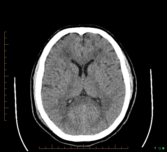 File:Cerebral fat embolism (Radiopaedia 85521-101220 Axial non-contrast 35).jpg