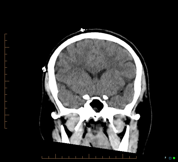 Cerebral fat embolism (Radiopaedia 85521-101220 Coronal non-contrast 25).jpg