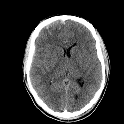 File:Cerebral hemorrhagic contusions- temporal evolution (Radiopaedia 40224-42753 Axial non-contrast 17).png