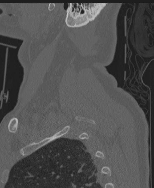 Cerebral hemorrhagic contusions and cervical spine fractures (Radiopaedia 32865-33841 Sagittal bone window 91).jpg