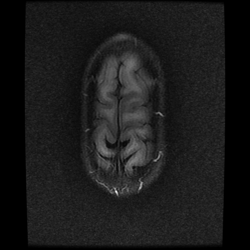 File:Cerebral manifestations of mucopolysaccharidosis type I (Radiopaedia 59171-66487 Axial FLAIR 20).jpg