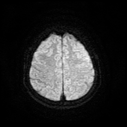 File:Cerebral metastases - melanoma (Radiopaedia 80972-94522 Axial DWI 23).jpg