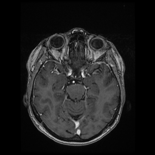 Cerebral metastases - melanoma (Radiopaedia 80972-94522 Axial T1 C+ 46).jpg