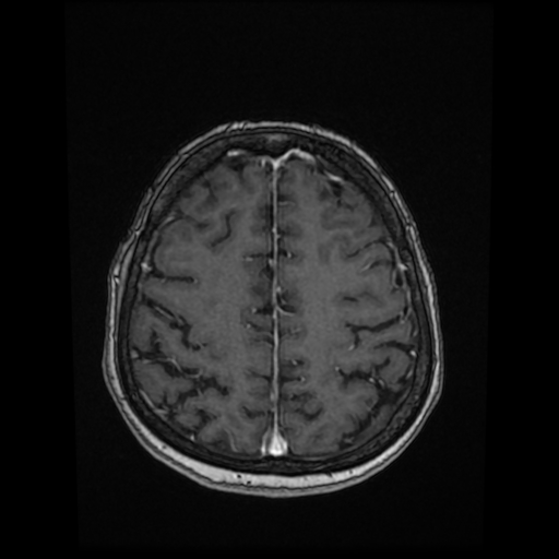 Cerebral metastases - melanoma (Radiopaedia 80972-94522 Axial T1 C+ 72).jpg